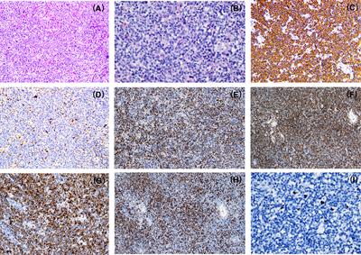Case report: Identification of atypical mantle cell lymphoma with CCND3 rearrangement by next-generation sequencing